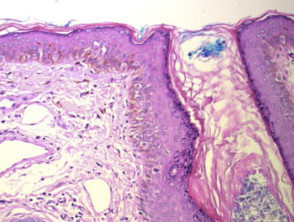 Histología del melanoma in situ