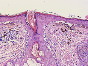 Histologie van melanoom in situ