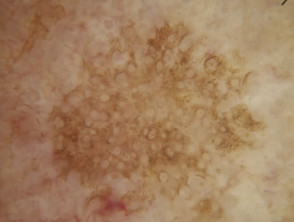 Círculos grises observados en la dermatoscopia de un lentigo solar facial.