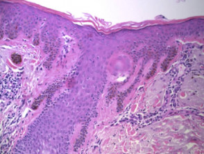 Histologie eines solaren Lentigo