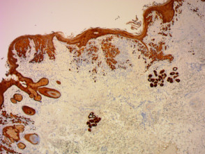 Liquen plano que muestra los cuerpos de Civatte en histología teñidos con citoqueratina x40