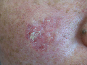 Lupus eritematoso cutáneo inducido por fármacos