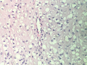Patología de la pápula fibrosa de células claras
