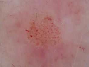 Dermatoscopia de acantoma de células claras