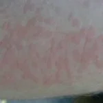 cold-urticaria3__protectwyjqcm90zwn0il0_focusfillwzi5ncwymjisingildfd-6986202-7659826-jpg-7157178