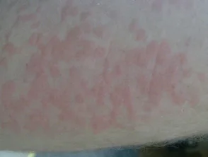 Orticaria da freddo