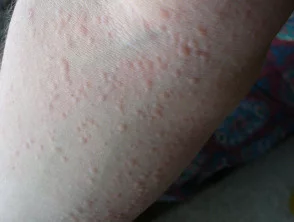 Orticaria da freddo