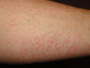 Orticaria da freddo