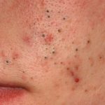 komedos2__protectwyjqcm90zwn0il0_focusfillwzi5ncwymjisingilde5xq-5554979-1673928-jpg-9505405