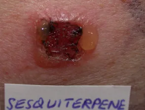 Allergia alle composite: patch test positivi