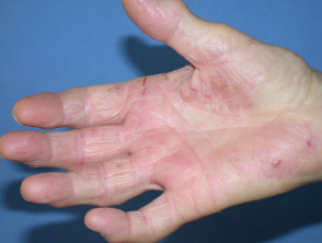 Alergia compositae: dermatitis de manos