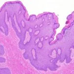 condyloma-acuminatum-figure-1__protectwyjqcm90zwn0il0_focusfillwzi5ncwymjisingildbd-7532330-4179664-jpg-6362679