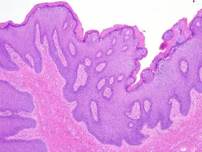 Condyloma acuminata Pathologie