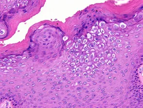 Condyloma acuminata Pathologie