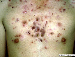 nodulocystische acne