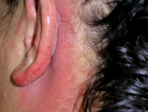 Dermatitis alérgica de contacto al tinte para el cabello