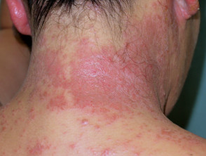 Dermatitis alérgica de contacto al tinte para el cabello
