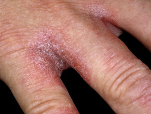 Dermatitis de las manos por exposición excesiva al agua.