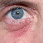 contact-dermatitis-eyelid-airborne__protectwyjqcm90zwn0il0_focusfillwzi5ncwymjisinkildg1xq-7264166-1743011-jpg-1533300