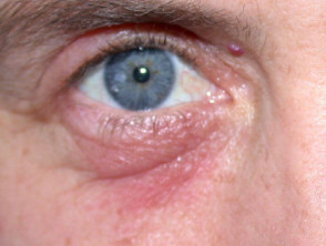 contact-dermatitis-eyelid-airborne__protectwyjqcm90zwn0il0_focusfillwzi5ncwymjisinkildg1xq-7264166-1743011-jpg-1533300