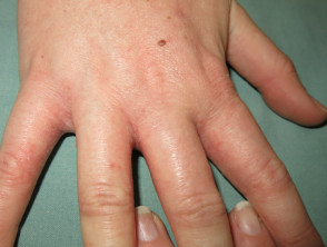Dermatitis de contacto por isocianato