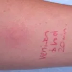 contact-orticaria1__protectwyjqcm90zwn0il0_focusfillwzi5ncwymjisingildfd-9135866-9169021-jpg-2894227