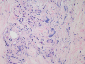 Histología del granuloma cutáneo debido a la enfermedad de Crohn, New Zealand Medical Journal.  2006