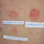cerotto-corticosteroide__protectwyjqcm90zwn0il0_focusfillwzi5ncwymjisingildfd-6127822-5599389-jpg-6195189