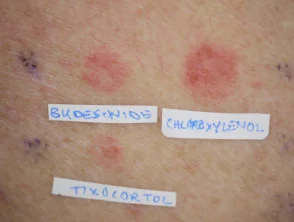 Patch test positivo per corticosteroidi topici