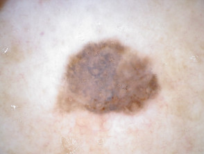 Melanoma in situ, vista de dermatoscopia no polarizada