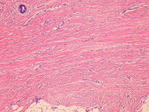 Patología del nevo del tejido conjuntivo fibroblástico