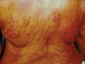 Mycosis fungoides