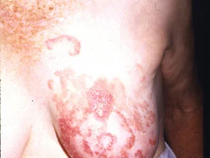 Mycosis fungoides