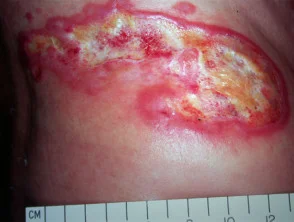 Mycosis fungoides