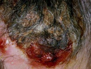 Placa infectada eccematosa en el linfoma de Hodgkin