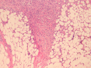Patología del histiocitoma fibroso profundo