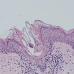 demodex__protectwyjqcm90zwn0il0_focusfillwzi5ncwymjisingildfd-1815103-1444501-jpg-5882675