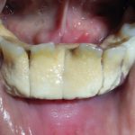 dental-plaque__protectwyjqcm90zwn0il0_focusfillwzi5ncwymjisingildfd-7479018-1275189-jpg-6090800