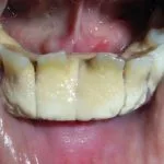 placca-dentale__protectwyjqcm90zwn0il0_focusfillwzi5ncwymjisingildfd-7479018-1275189-jpg-6090800