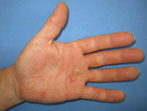 Dermatitis de la mano por alergia a los guantes de goma