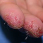derm-finger__protectwyjqcm90zwn0il0_focusfillwzi5ncwymjisingildfd-5179695-6092176-jpg-1087424