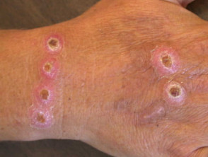 Dermatitis artefacta