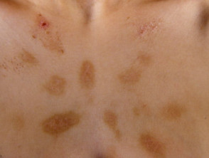 Dermatitis artefacta