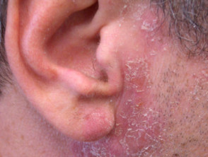 Dermatitis aerotransportada por alergia al epoxi