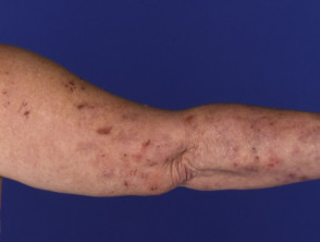Dermatitis herpetiforme del codo