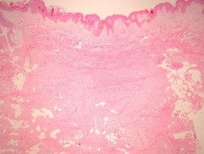 Dermatomofibroom pathologie