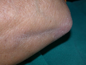 Dermatomiositis del brazo 
