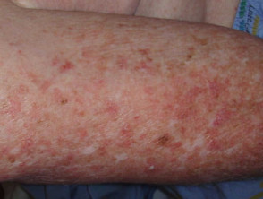 Dermatomyositis des Arms 