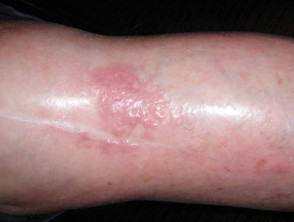 Dermatomiositis del brazo 