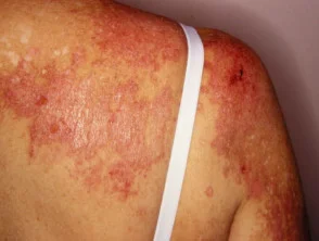 Dermatomiosite del braccio 